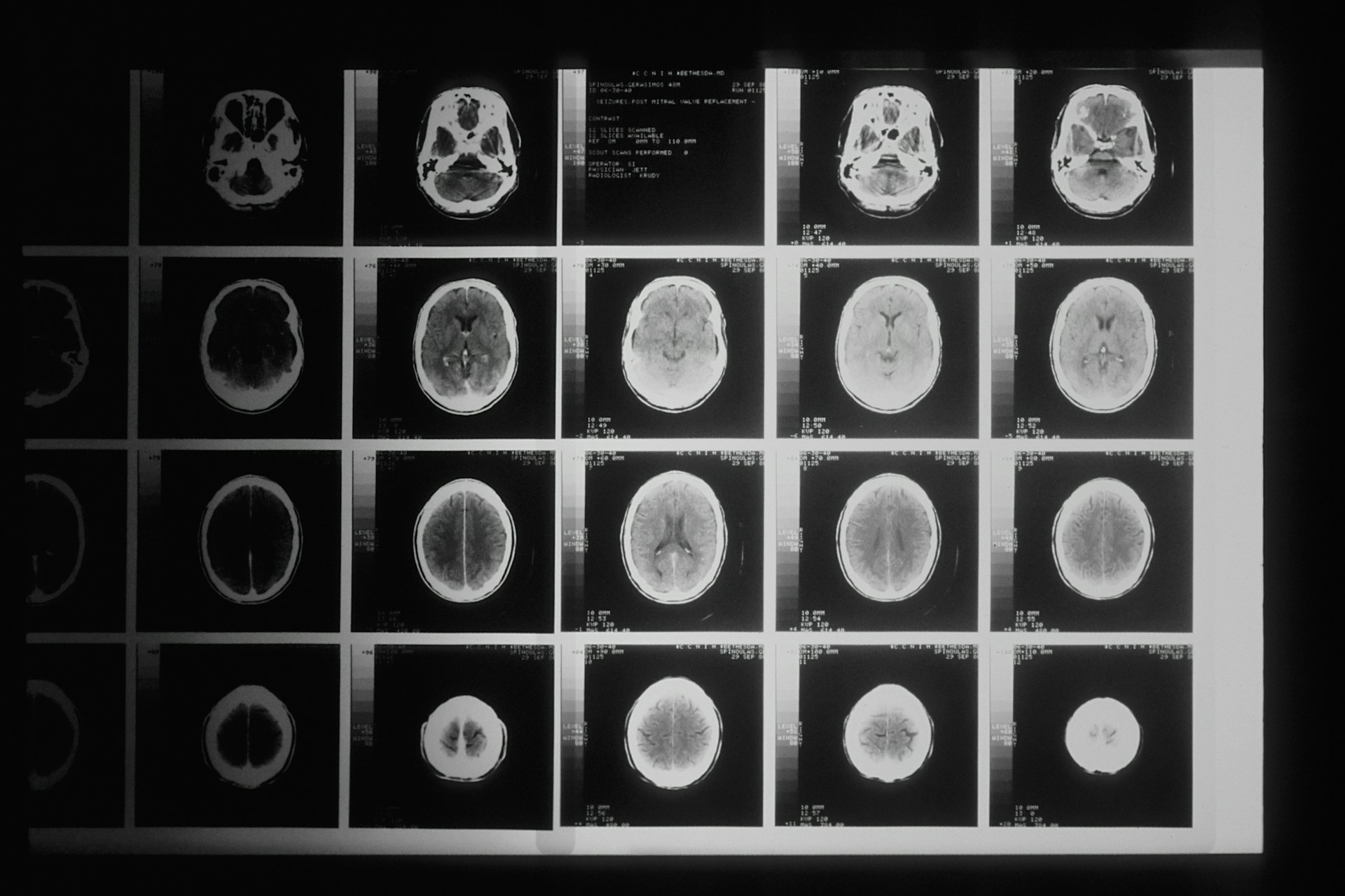 A lightbox holding a grid of cross-sectional head scans, seen out of focus